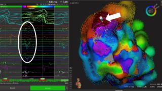 Abblidung einer 3D-Darstellung der Ausbreitung einer Ventrikülären Tachykardie