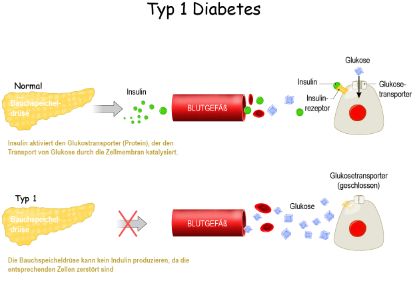 Diabetes-Typ-2 ist vermeidbar – und heilbar - Asklepios Gesundheitsmagazin